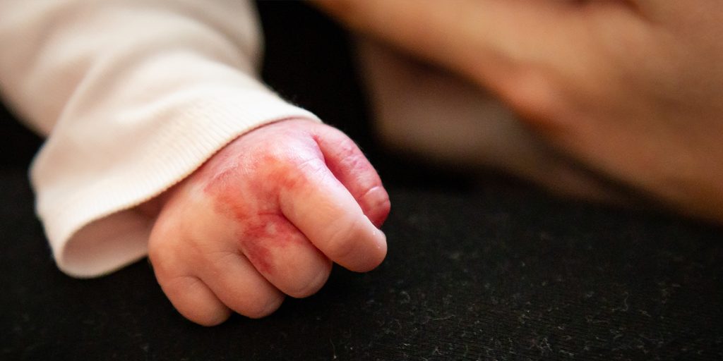 Newborn or Infant With a Skin Concern Dermatology KidsHeart Alain