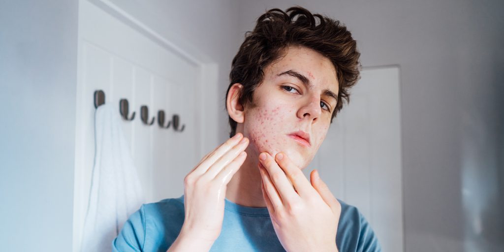 Teenage Acne or Hormonal Skin Changes Dermatology KidsHeart Alain