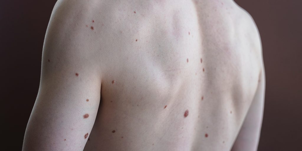 Worried About a Mole, Birthmark, or Pigmentation Change Dermatology KidsHeart Alain