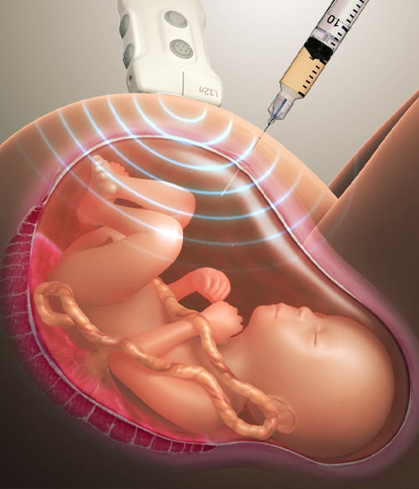 Amniocentesis Obstetrics & Gynecology KidsHeart Dubai Abu Dhabi Alain
