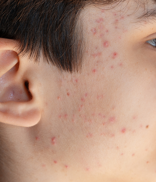 Acne Dermatology KidsHeart Alain