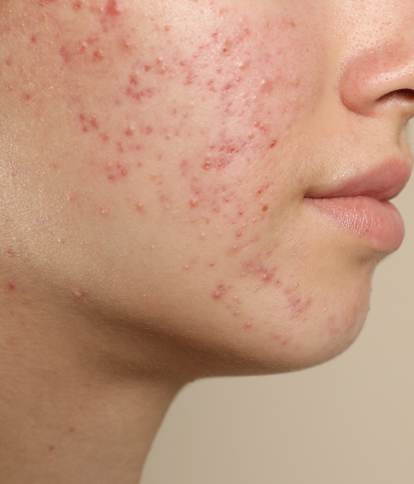Acne Dermatology KidsHeart Alain