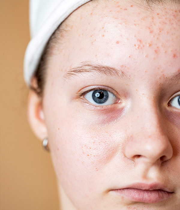 Adolescent Skin Care Programs Dermatology KidsHeart Alain