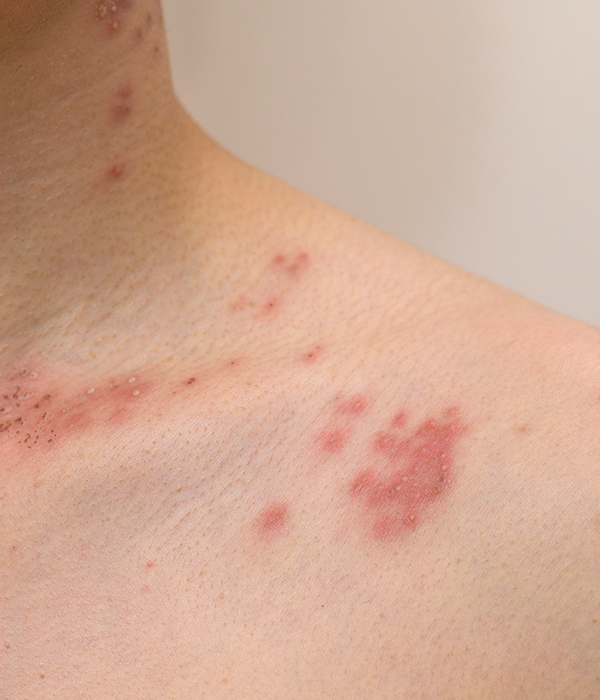 Contact Dermatitis and Allergic Skin Reactions Dermatology KidsHeart Alain