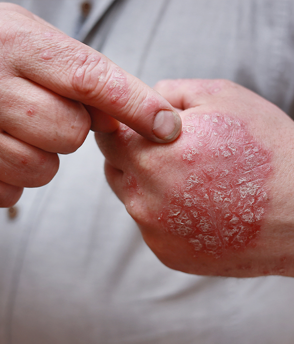 Contact Dermatitis and Allergic Skin Reactions Dermatology KidsHeart Alain