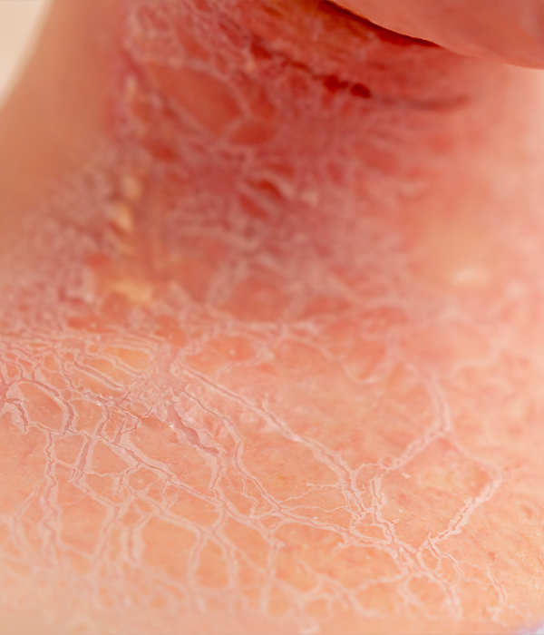 Eczema and Atopic Dermatitis Dermatology KidsHeart Alain