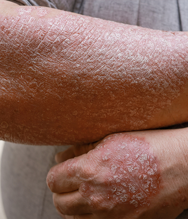 Eczema and Atopic Dermatitis Dermatology KidsHeart Alain