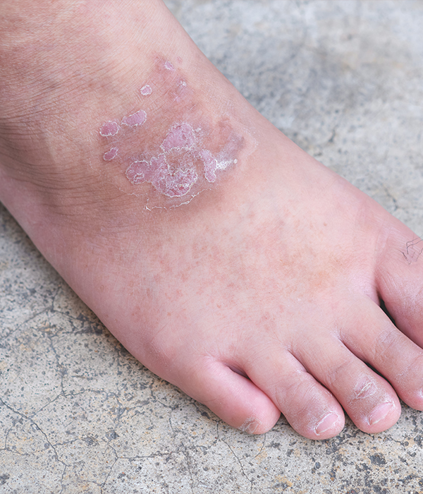Fungal Infections Ringworm, Candidiasis, and Others Dermatology KidsHeart Alain