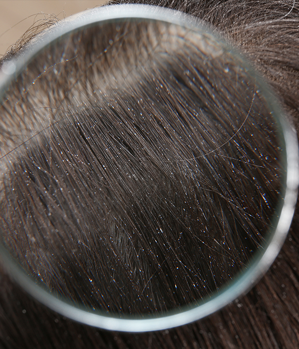 Hair and Scalp Disorders Dermatology KidsHeart Alain