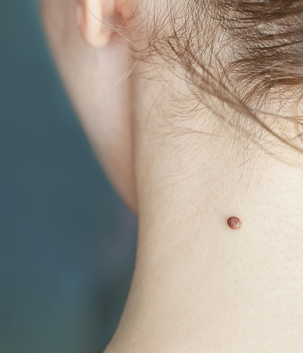 Moles, Birthmarks, and Pigmentation Concerns Dermatology KidsHeart Alain