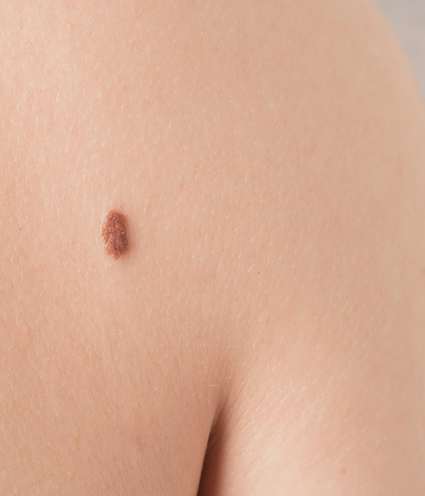 Moles, Birthmarks, and Pigmentation Concerns Dermatology KidsHeart Alain
