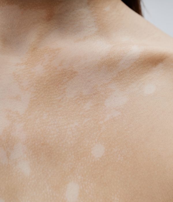 Morphea and Lichen Sclerosis Dermatology KidsHeart Alain