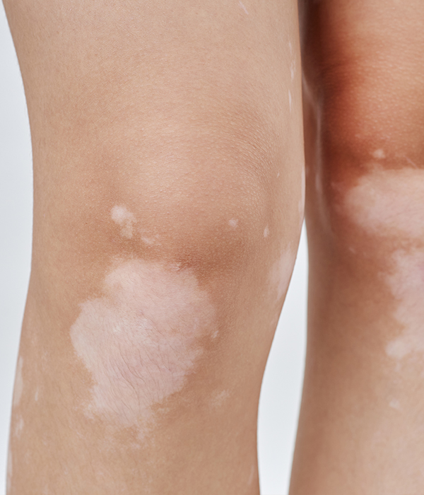 Morphea and Lichen Sclerosis Dermatology KidsHeart Alain