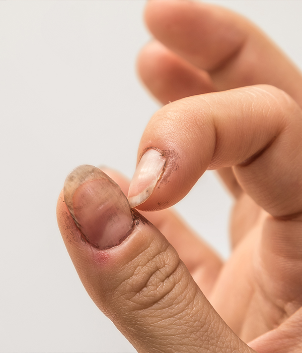 Nail Disorders Dermatology KidsHeart Alain