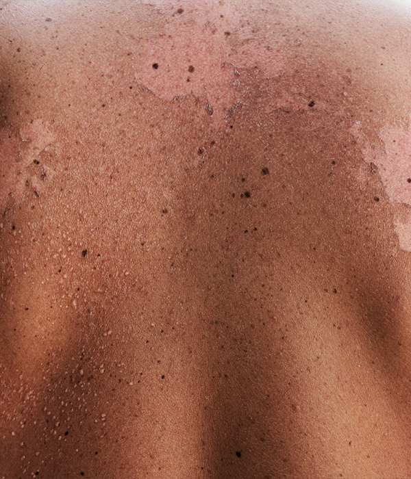 Psoriasis Dermatology KidsHeart Alain