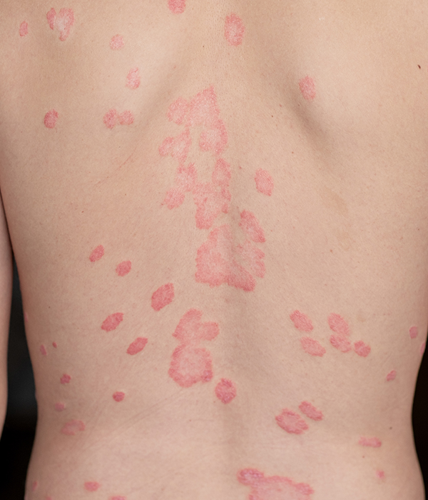 Psoriasis Dermatology KidsHeart Alain