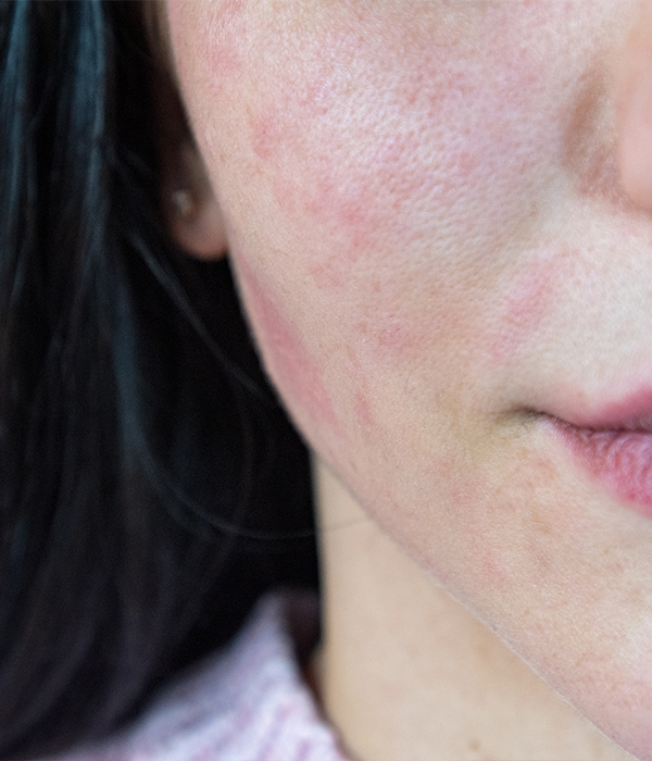 Rosacea and Facial Skin Sensitivity Dermatology KidsHeart Alain