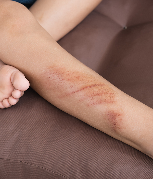 Scar Management Dermatology KidsHeart Alain