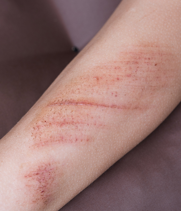 Scar Management Dermatology KidsHeart Alain