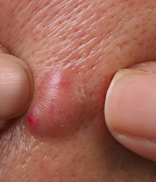 Warts and Viral Skin Growths Dermatology KidsHeart Alain